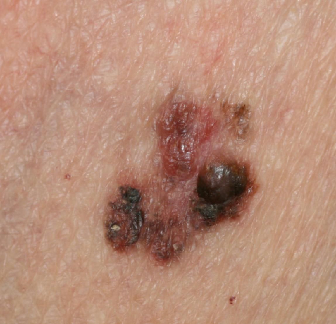 Facial Skin Cancer